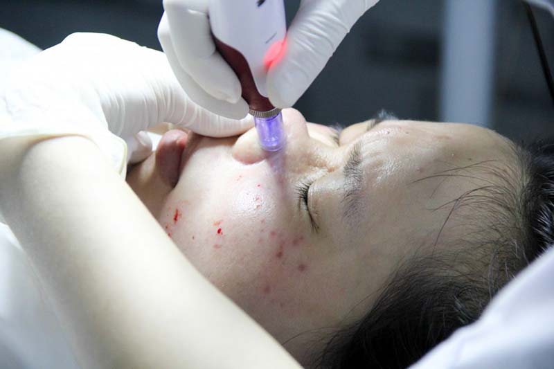 Taza skin clinic spa trị mụn uy tín Đà Nẵng
